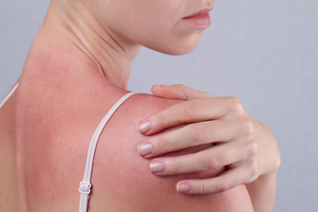 poparzenia słoneczne